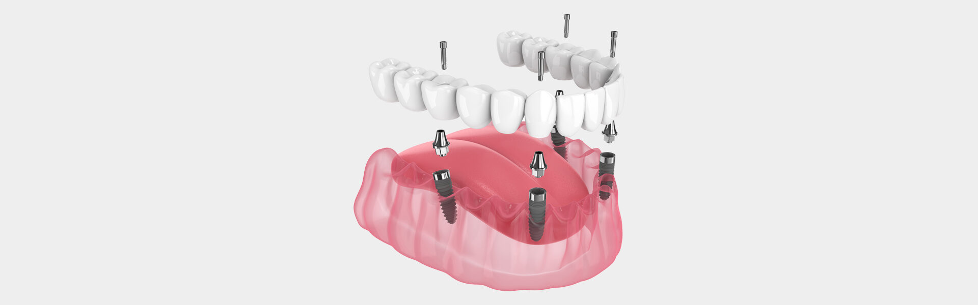 All-on-4® Dental Implants in Portland, OR