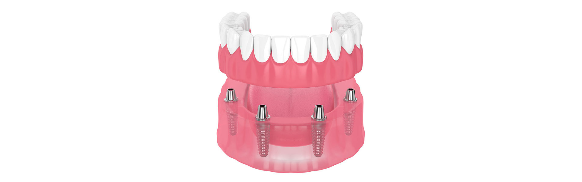 Implant Retained Dentures in Portland, OR