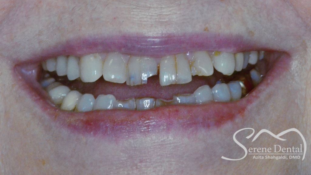 Before Porcelain Crowns on 2 Front Teeth and Composite Restorations
