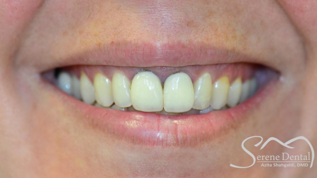 Before Invisalign, Zoom! Teeth Whitening, and the Replacement of 2 Front Crowns
