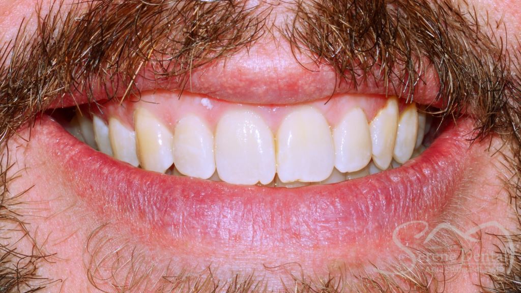 Invisalign After Teeth