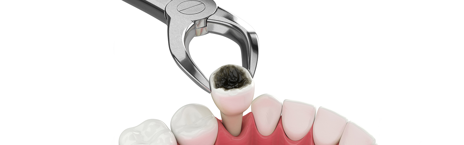 Understanding Tooth Extraction: When Is It Necessary?